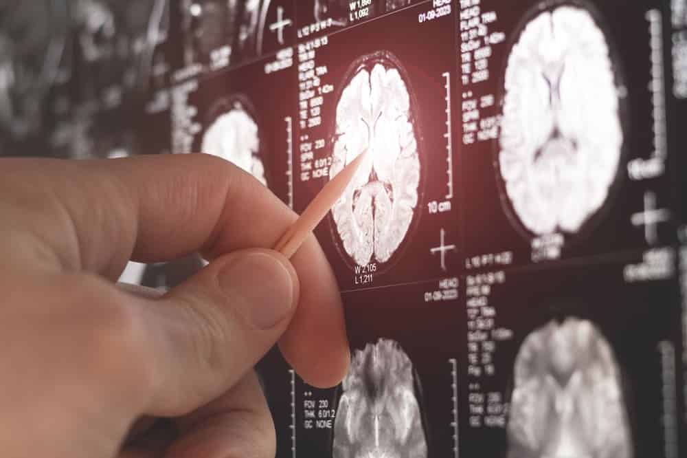 MRI for Brain