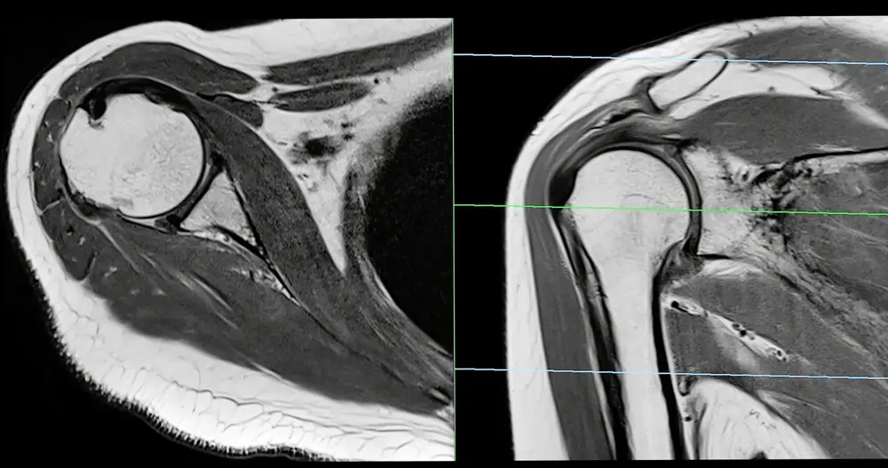 MRI scan of a shoulder joint showing detailed internal structures for diagnosing shoulder pain.