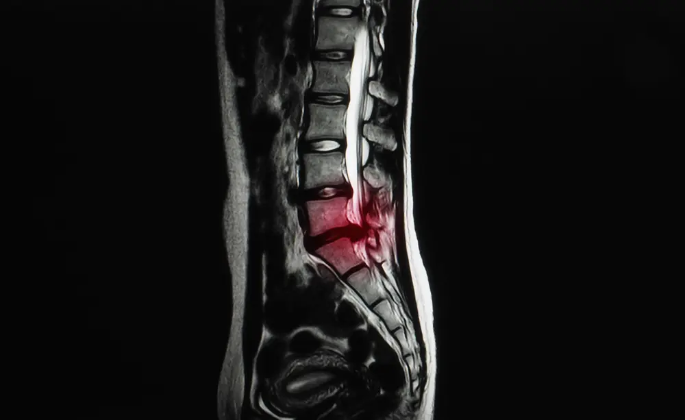 Sagittal MRI of lumbar spine showing herniated intervertebral disc at L5/S1, illustrating cause of back pain and sciatica.