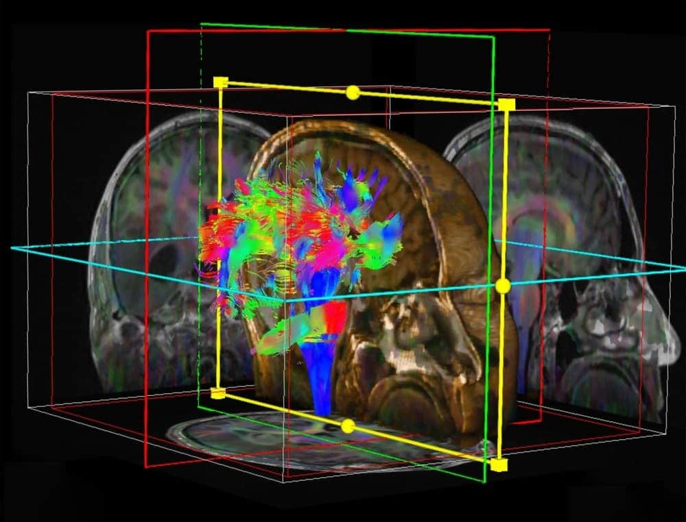 Imágenes por tensor de difusión