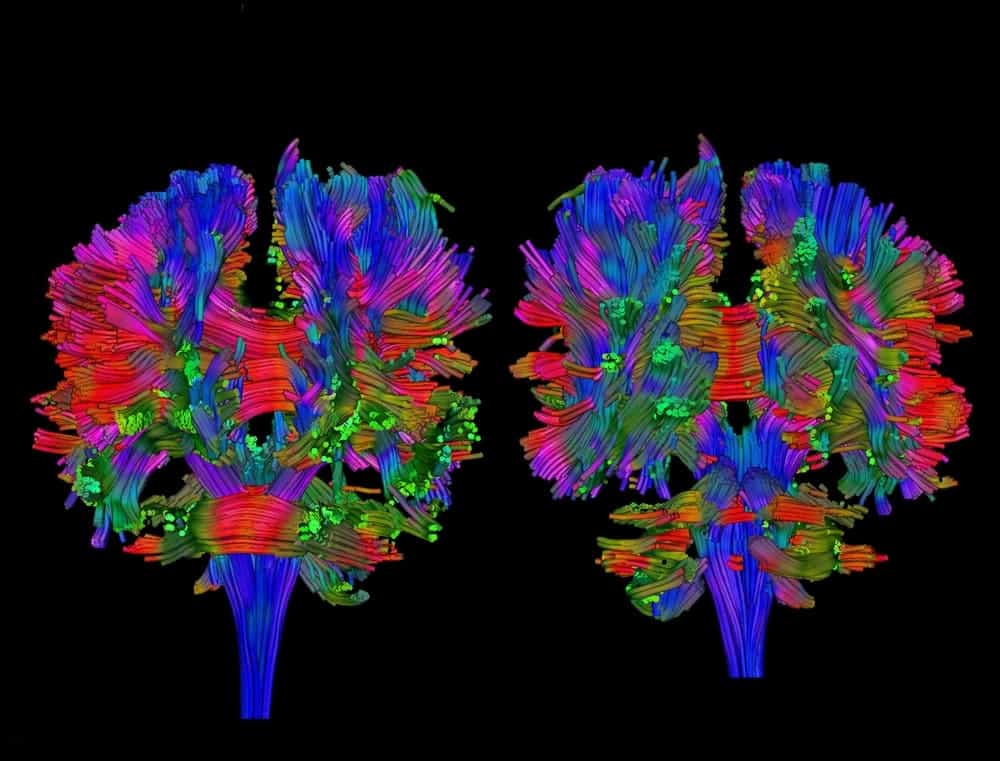 DTI MRI